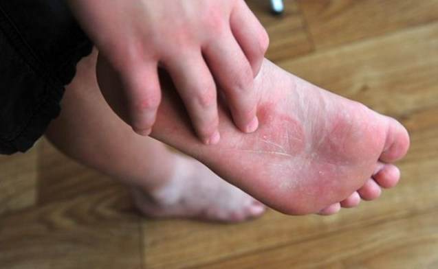 Jakie są objawy i objawy stopy sportowca